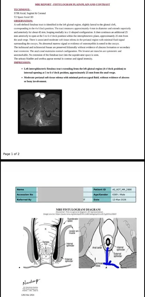fistula MRI report