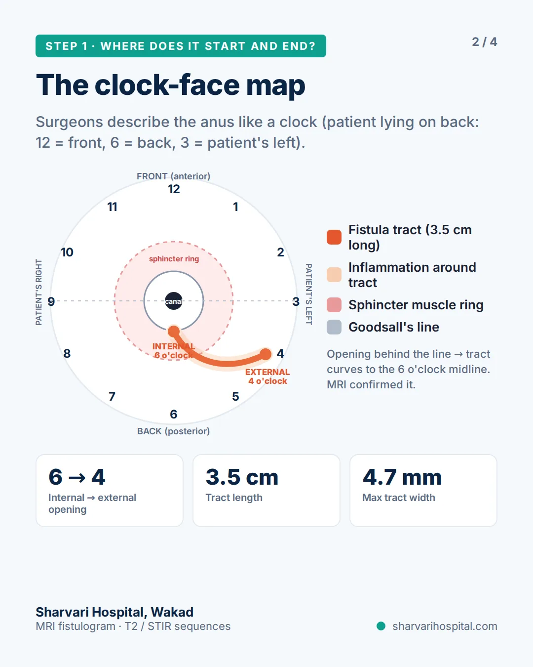 MRI clock-face map of a trans-sphincteric anal fistula: internal opening at 6 o'clock, external opening at 4 o'clock — Dr. Kundan Kharde, Pune