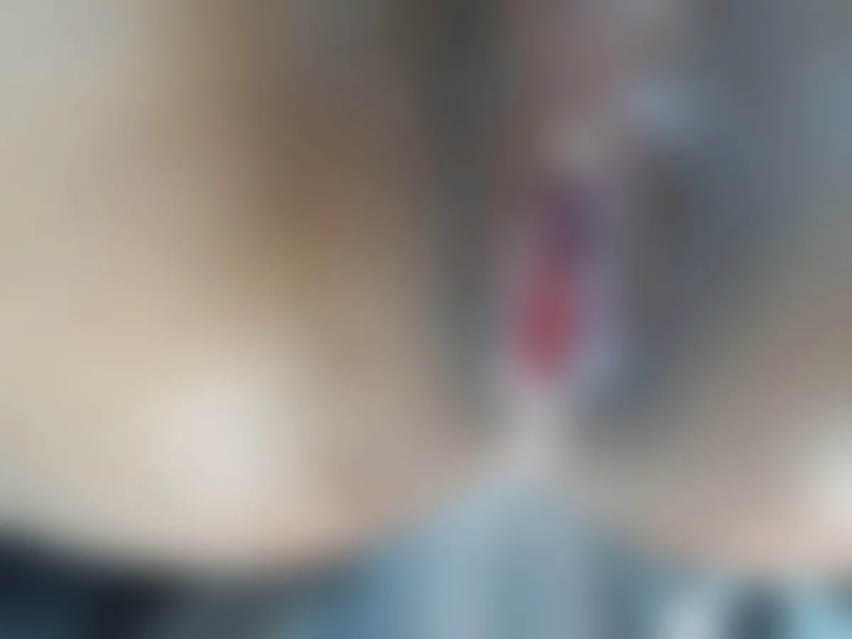 Blurred pre-operative view of severe anal stenosis with a non-healing wound after piles surgery elsewhere, before stricture release and mucoplasty — Dr. Kundan Kharde, Pune
